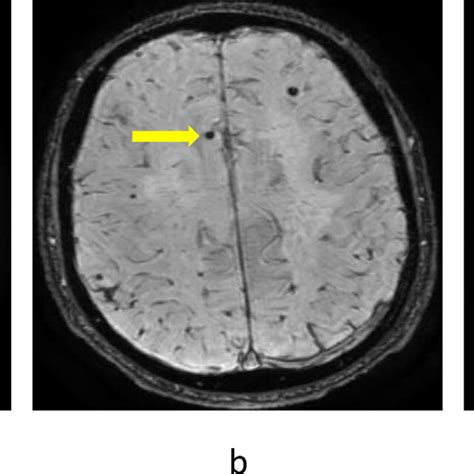 Neuroimaging Characteristics Of Cerebral Microbleeds Cmbs In Mr