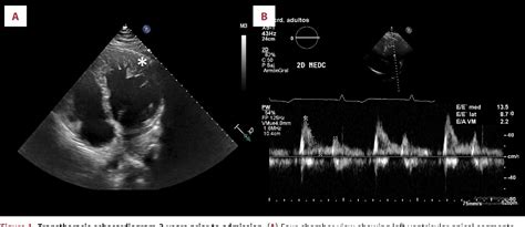 PDF Acute Mitral Regurgitation Due To Chordae Tendineae Rupture A