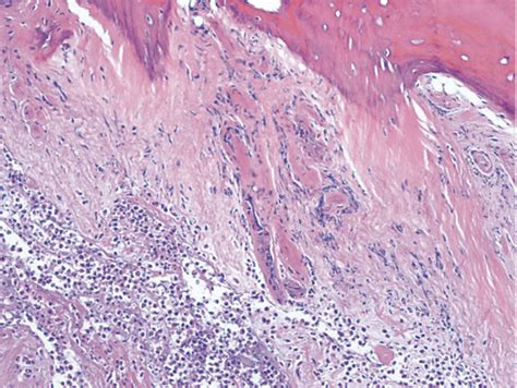 MSK Exam 3 Pathology Bone Flashcards Quizlet