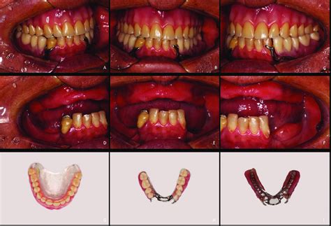 Preoperative Intraoral Photographs A B C Preoperative Intraoral