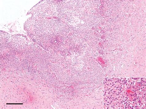 Histology Of Oligodendroglioma Uniform Cells With Small Round Nuclei