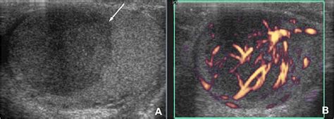 Benign And Malignant Intratesticular Lesions Sonographic Features