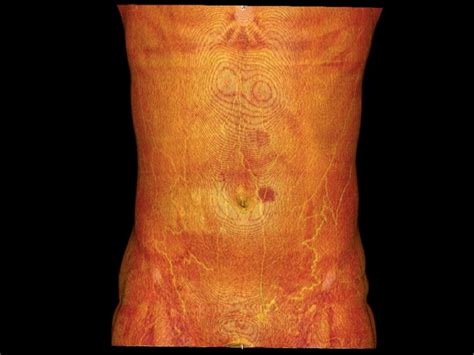 Patent Paraumbilical Vein On Ultrasound Not Always Cirrhosis Semantic Scholar