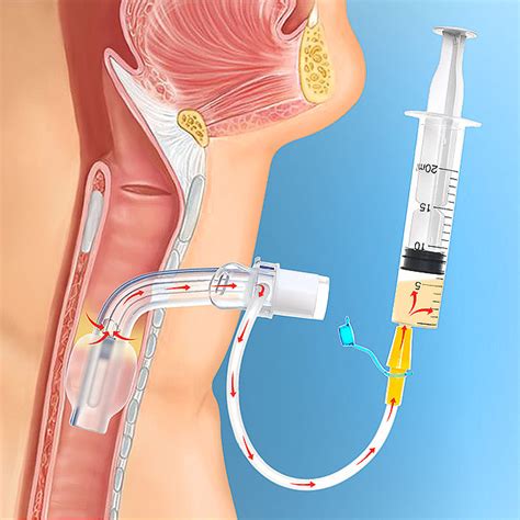 Tracheostomy Tubes Suction Plus