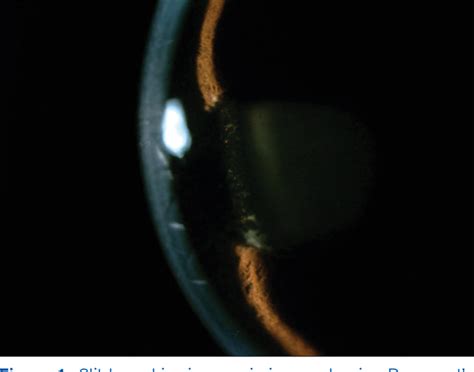 Bilateral Acute Retinal Necrosis Associated With Bilateral Uveal