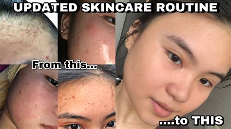 Paano Mawala Ang Pimples Skincare Routine For Sensitive Skin