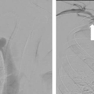 antegrade technique   guidewire passed antegrade