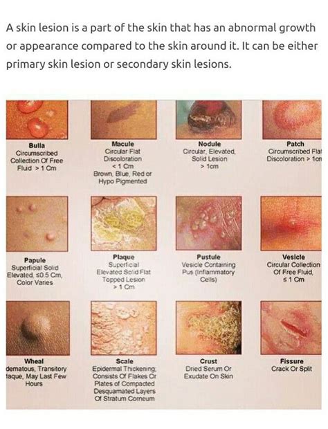 skin cancer types of skin lesions chart Lesion ems solutions