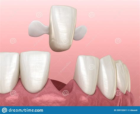 Maryland Bridge Made From Ceramic Front Tooth Recovery Medically