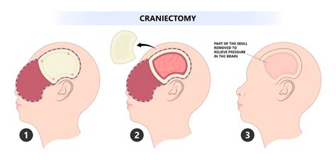 Craniotomy (Brain Surgery) in Singapore - Chou Neuroscience Clinic