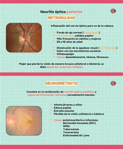 Neuritis óptica posterior Javier Rios uDocz