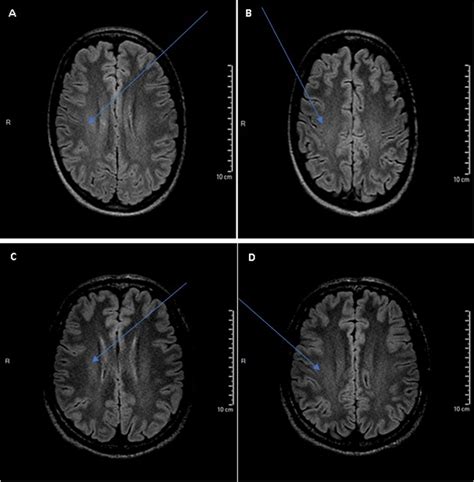 Brain MRI Abnormalities In ATL1 Patients Abnormal Signals Of White