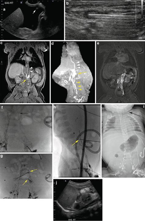 Vascular Interventions Lymphangiography And Thoracic Duct Embolization