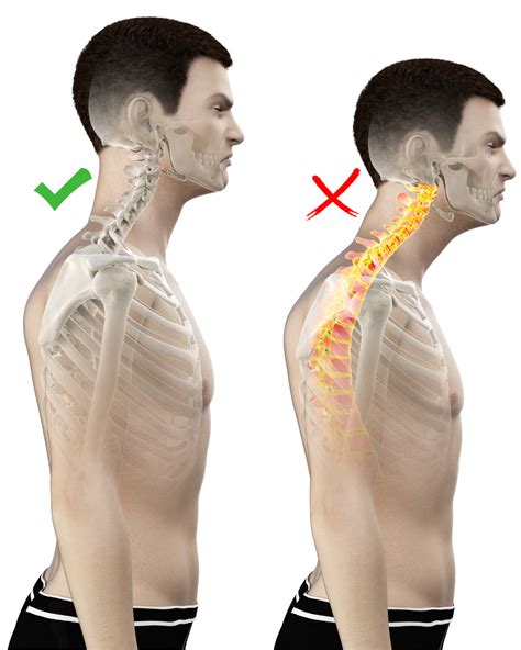 Forward Head Posture Muscles Involved