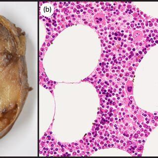 A Macroscopic Findings Of The Resected Specimen Show A Large Yellow