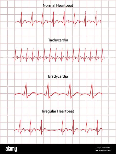 Ecg Ekg Pathology Hi Res Stock Photography And Images Alamy