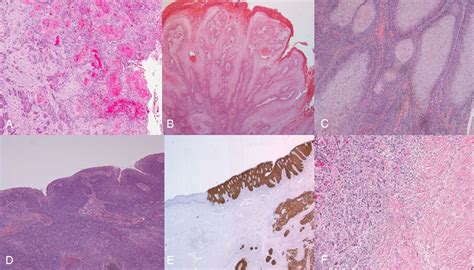 Review Of In Situ And Invasive Penile Squamous Cell Carcinoma And Associated Non Neoplastic