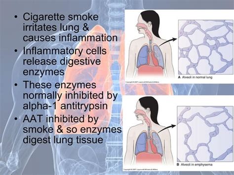 Diseases Of The Respiratory System Ppt