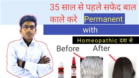 Safed Balo Ko Kala Karne Ka Ilaj Premature Grey Hair Homeopathic