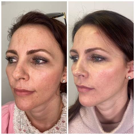 Profhilo Before And After Photos Australia Bio Remodelling Filler