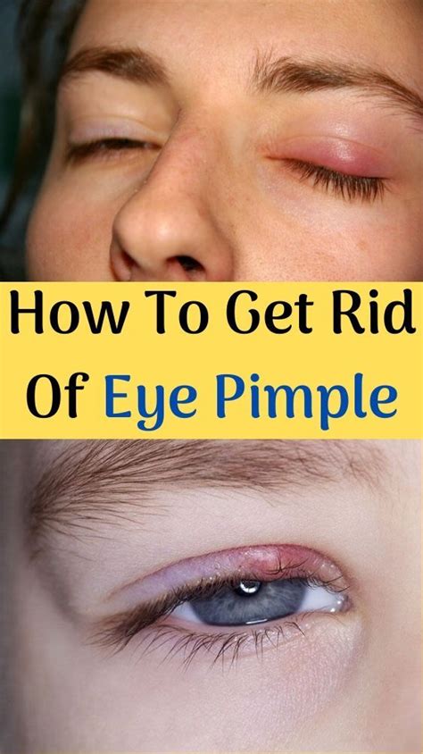 How To Get Rid Of Eye Pimple Skin Routine Skin Care Tutorial Pimples