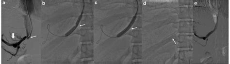 A Ultrasound Gray Scale Image Showing Left Hepatic Vein Lhv Ostial