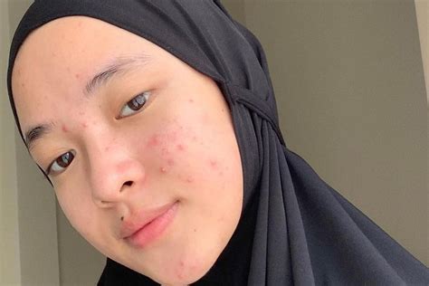 Nisa Sabyan Unggah Foto Jerawatan Netizen Salah Pilih Suami Zona