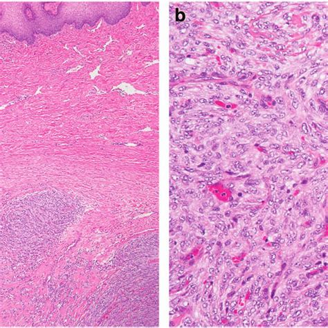 Lipoma Like Well Differentiated Liposarcoma Of The Esophagus A