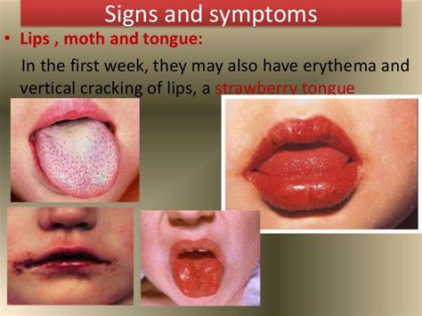 Kawasaki Disease Causes Symptoms Treatment And Prevention