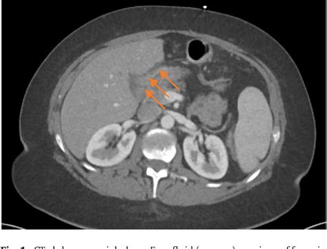 Figure 1 from Perforated pyloric ulcer 13 years after Roux-en-Y gastric ...