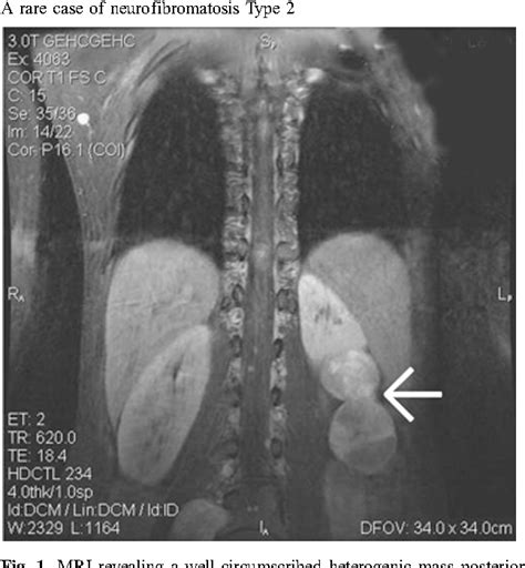 Figure From A Rare Retroperitoneal Schwannoma In A Patient With