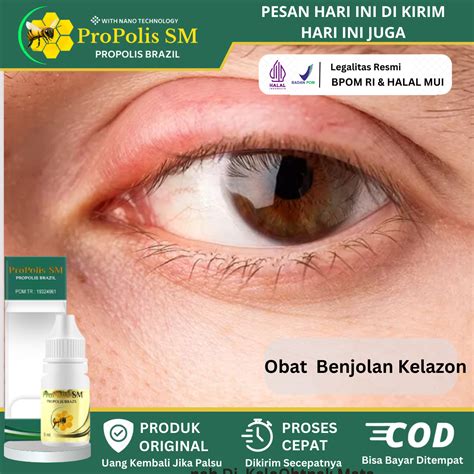 Jual Obat Penghilang Benjolan Kalazion Benjolan Di Kelopak Mata Mata