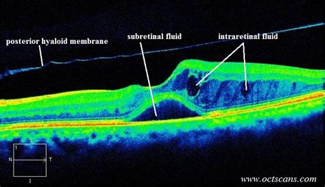 Clinically Significant Macular Edema Oct