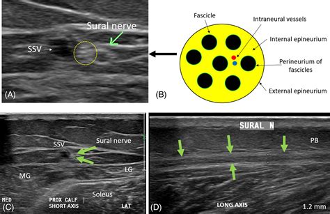 Sonographic Imaging And Assessment Of The Sural Nerve Fenech 2023