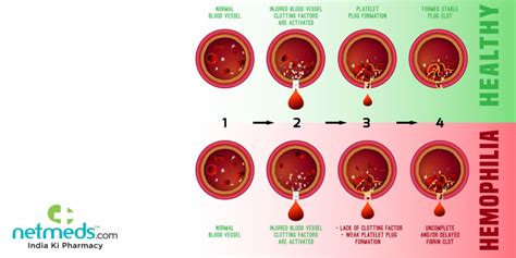 World Haemophilia Day 2021 Causes Types And Treatment For This