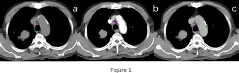 Figure 1 From Differentiation Of Mediastinal Metastatic Lymph Nodes In Nsclc Based On Radiomic