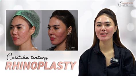 Hasil Rhinoplasty Di Jakarta Bagus Banget Plasthetic Clinic Youtube