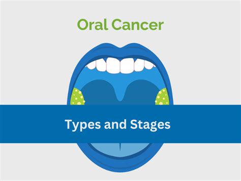 Stages of Oral Cancer | TNM Staging of oral cancer