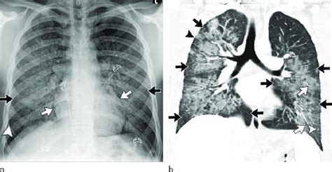 Images show electronic cigarette or vaping product use-associated lung... | Download Scientific ...