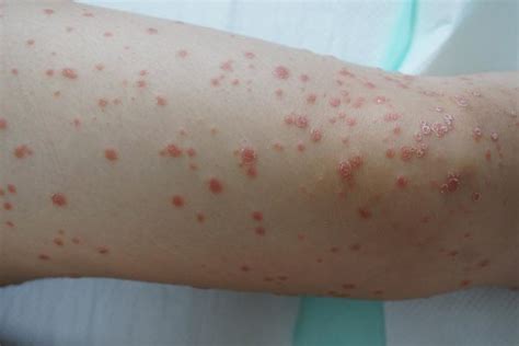 Psoriasis In Children: Symptoms, Types & How To Deal With It