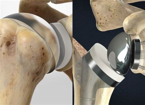 Reemplazo Articular De Hombro Por Artrosis O Artritis Dr Byron