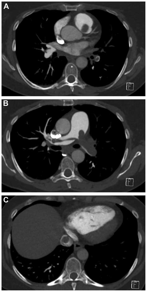 Surgical Management Of Intravenous Leiomyomatosis With Intracardiac