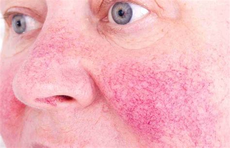 5 Natural Remedies To Get Rid Of Rosacea Market Bosworth The