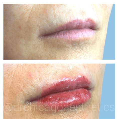 Lip Fillers Before And After Photos Chicago Aesthetics