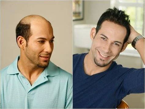 Hair Weaving For Men in Civil Lines, New Delhi | ID: 6623549448