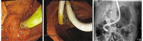 Endoscopic Retrograde Cholangiopancreatography Image Of Common Bile