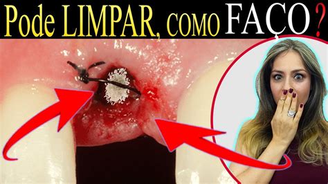 Como Fa O Pra Higienizar O Lugar Da Cirurgia Extrai Um Dente Como Fa O