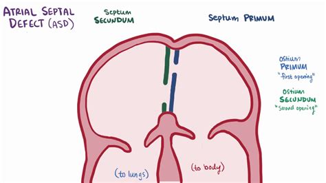 Atrial Septal Defect Fetal Ultrasound