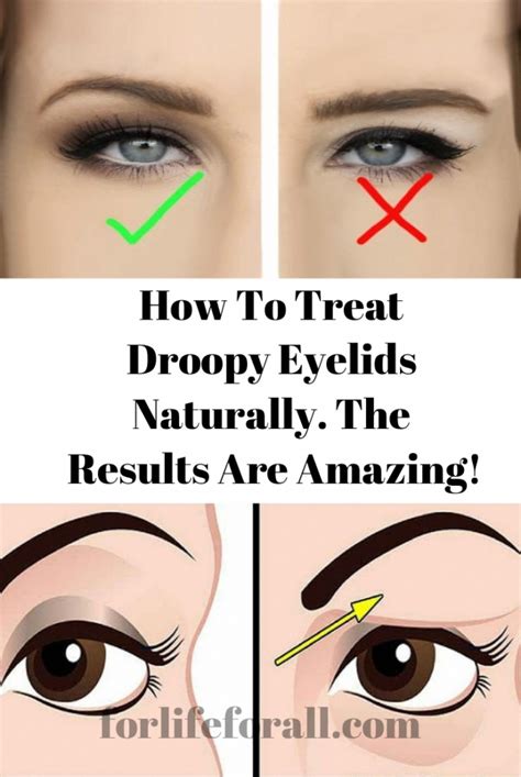 How To Treat Droopy Eyelids Naturally The Results Are Amazing