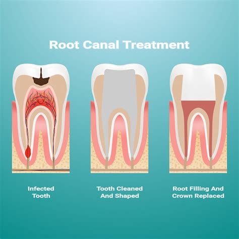 Premium Vector Pulpitis Root Canal Therapy Infected Pulp Is Removed